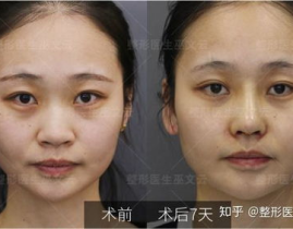 鼻翼缩小整形,揭秘鼻翼缩小整形的魅力与技巧